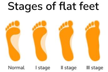 Flat Feet (Pes Planus)