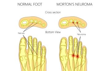 Neuroma Excision