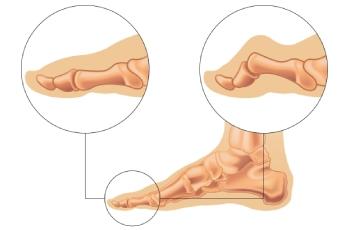 Hammer Toe Correction (Arthroplasty or Fusion)